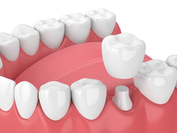 The Dental Crown Process: Repairing Teeth