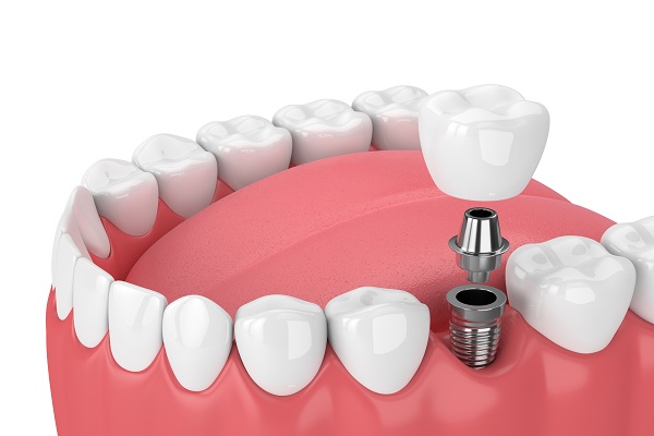 Dental Implants Northridge, CA