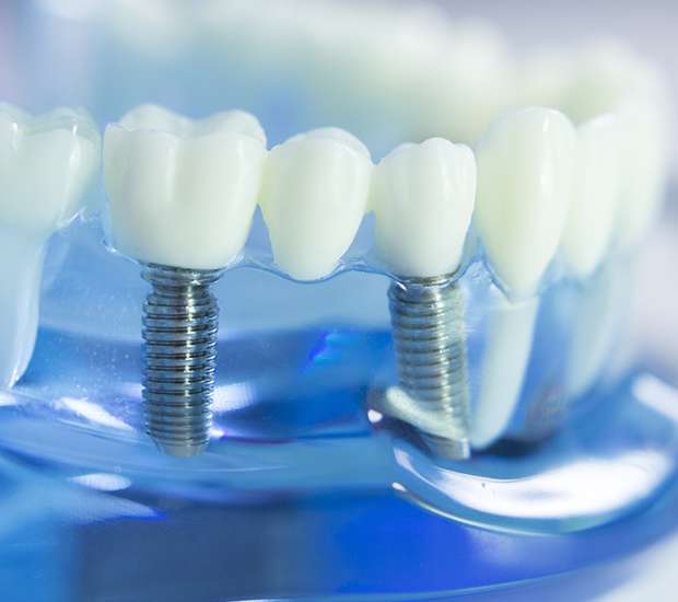 Northridge Dental Implants