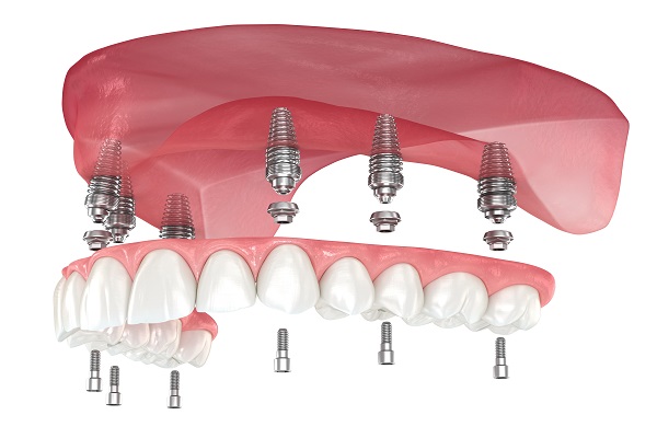 Implant Supported Dentures Northridge, CA