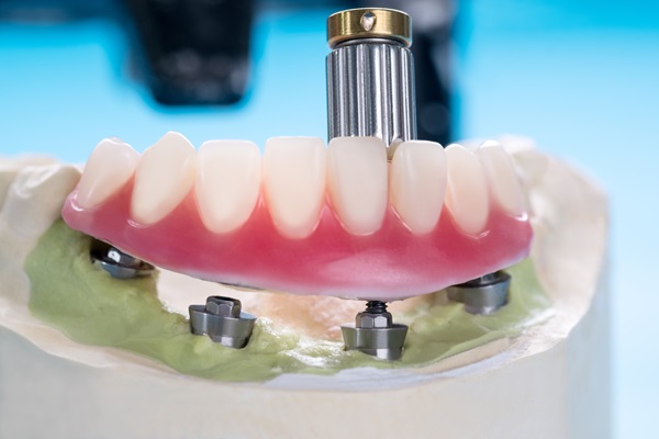 Common Questions About Implant Supported Dentures