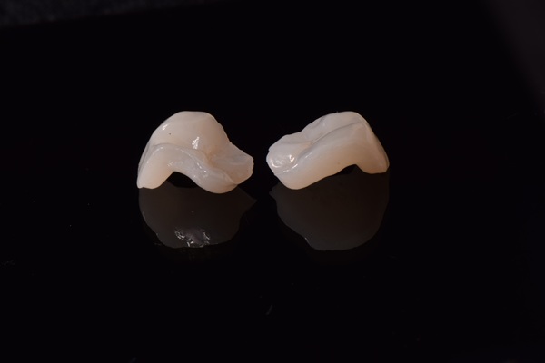 How Partial Crowns Can Help With Damaged Teeth